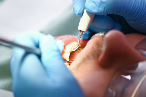 Best Emergency Wisdom Teeth Removal in Clute, TX